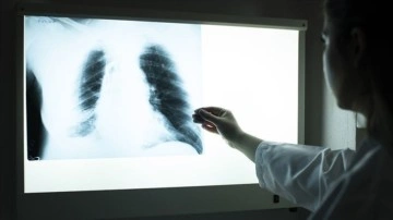 Kovid-19 sürecinde dünyada tüberküloz tanı oranı düştü, hastalığa bağlı ölümler arttı